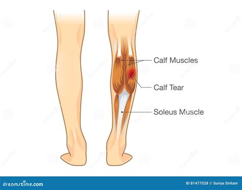 Calf Muscle Tear