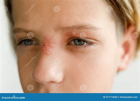 Large Red Rash on the Nose and Over the Child S Eye - Dermatolonia ...