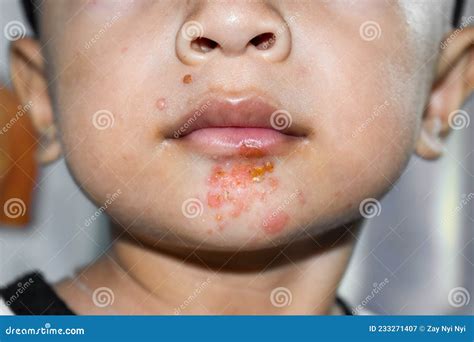 Staph Infection Rash Toddler at Bruce Moreno blog