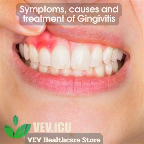 Gingivitis Treatment Medicine at Albert Jarman blog