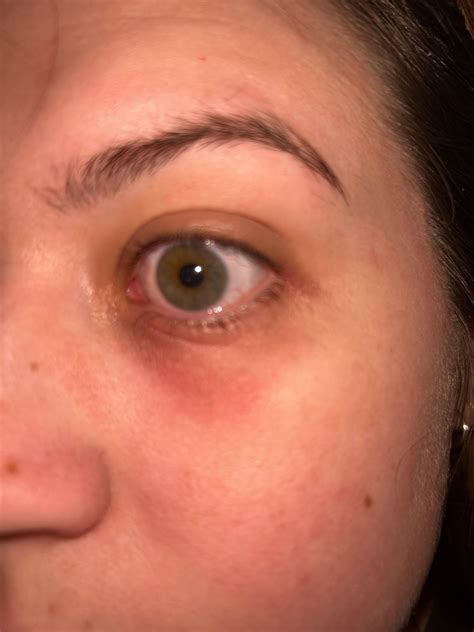 Redness under eye : r/skin