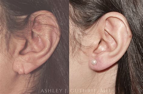 Earlobe Repair & Reduction - Before & After Gallery