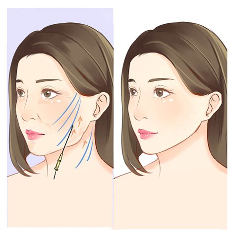 Can I Get a V-Shape Face Without Surgery? Answered by Beverly Wilshire Medical Centre | Erufu Care