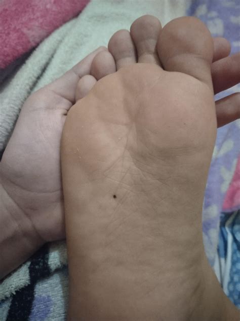 Got a small mole under my feet. I didn't have this before. IS IT NORMAL to grow new moles on ...