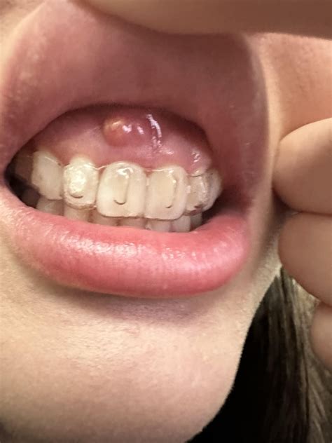 Help! Woke up with this gum boil/pimple? Should I be concerned? : r ...