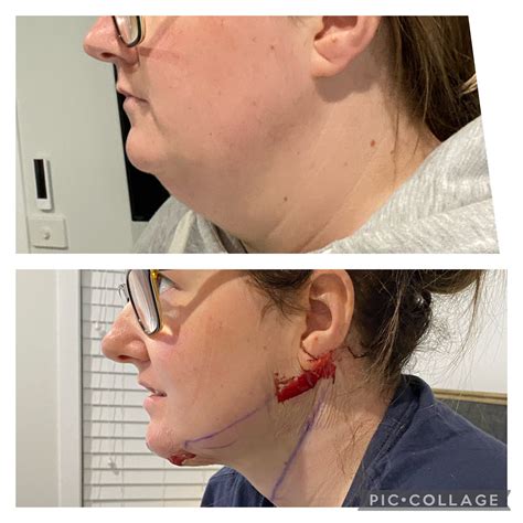 Chin And Neck Lipo Recovery at Amparo Lisi blog