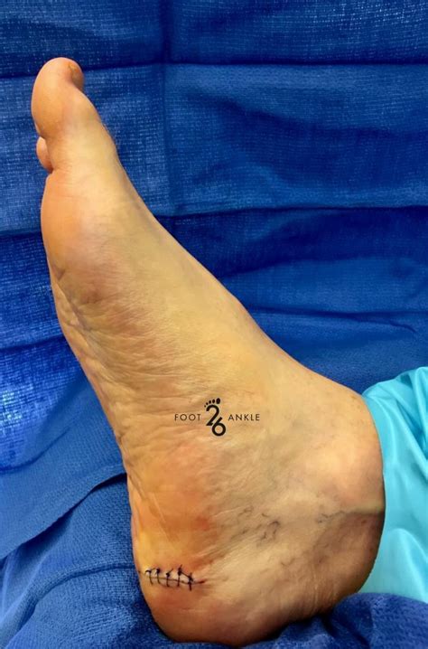Heel Pain Surgery: Plantar Fasciitis - 26 Foot & Ankle