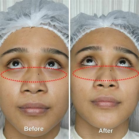 Dark Eye Circle Treatment Malaysia at Larry Hinojosa blog