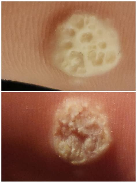 Is this a wart on my lip? : r/Warts