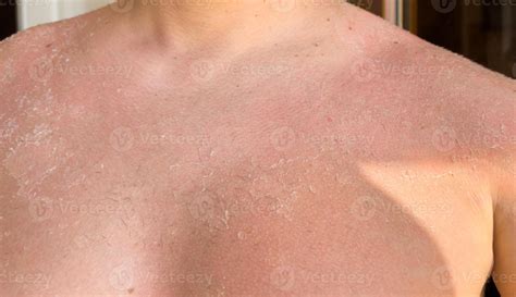 Sunburn, peeling skin, burns, skin problem, health, summer and sun 71282744 Stock Photo at Vecteezy