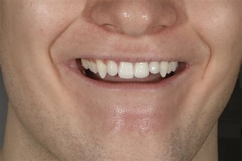 Composite Edge Bonding to Hide Small Misalignments & Long, Sharp Canine Teeth - Maison Dental