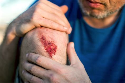 Abrasion Definition Scabs: What They Are And How They Heal