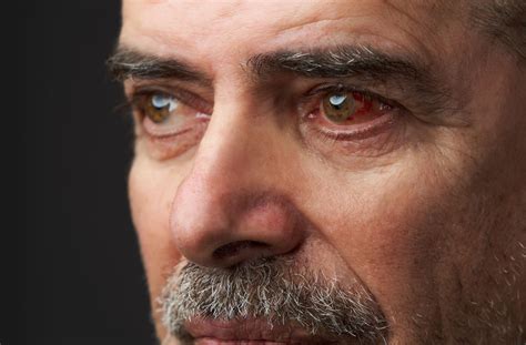 What Happens If You Don’t Treat Dry Eyes?