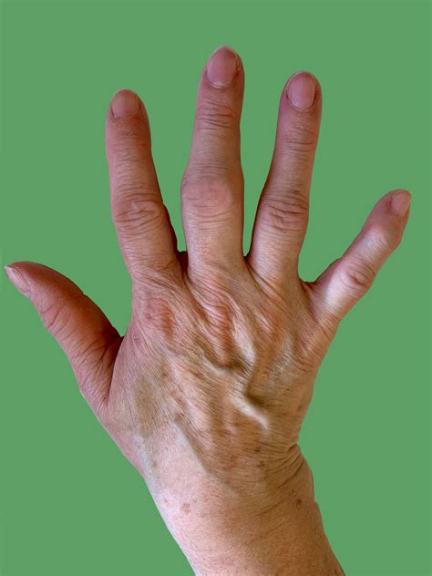 Osteoarthritis in the Hand – Fife Virtual Hand Clinic