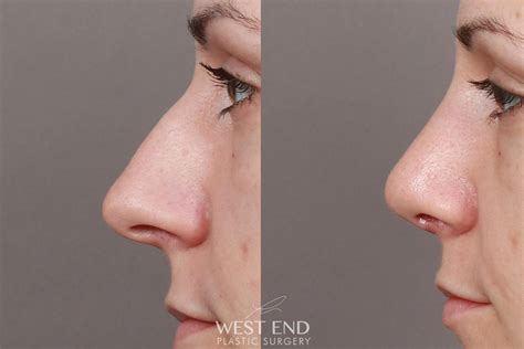 Septoplasty Before And After