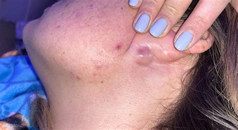 Bump behind ear : r/DermatologyQuestions