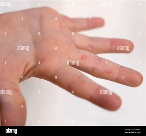 Child foot red itchy hi-res stock photography and images - Alamy
