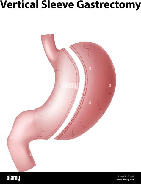 Illustration of vertical sleeve gastrectomy Stock Vector Image & Art - Alamy