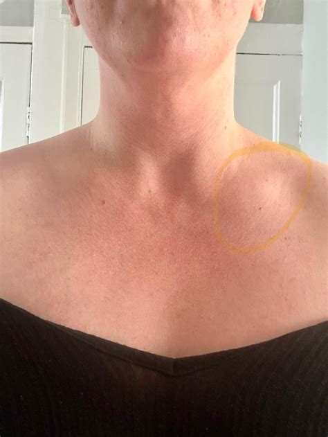 Enlarged Clavicle Lymph Neck Evaluation Of Neck Masses In Adults