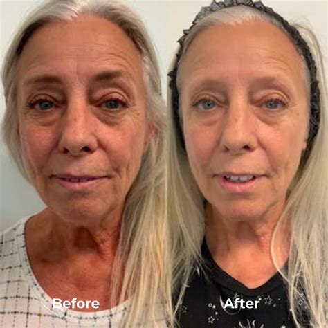 RF Microneedling Before & After Results