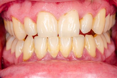 What Is Gingivitis Explained Here Divine Dental Care - vrogue.co