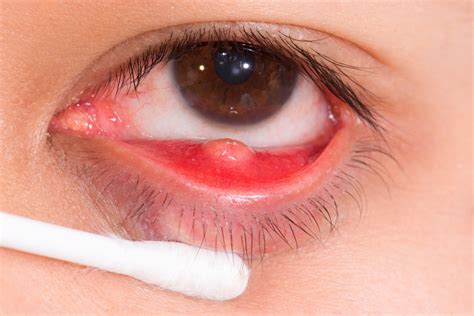 Eye Floaters: Causes, Symptoms and Treatments