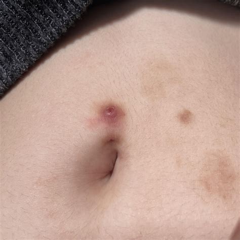 Has my navel piercing rejected/is rejecting or is it just infected? if ...
