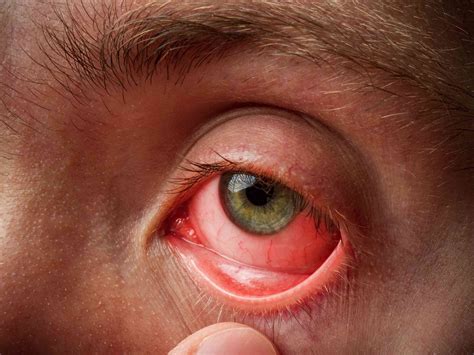 Allergic Conjunctivitis Vs Bacterial Conjunctivitis