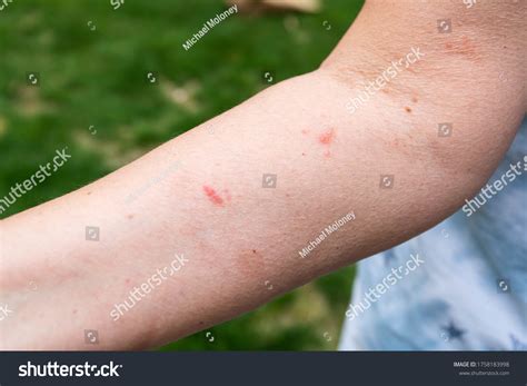 Poison Ivy Blisters Accidentally Popped