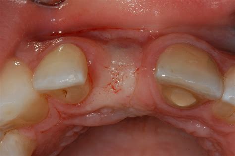 Healing Of Tooth Extraction And Bone Graft at Colleen Miller blog