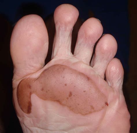 Scaly Blister Rash On Feet