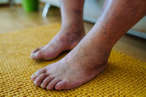 Why Are My Feet Purple? | American Endovascular