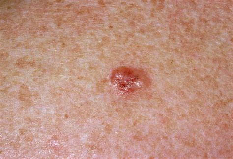 Skin Cancer On Face What Does It Look Like