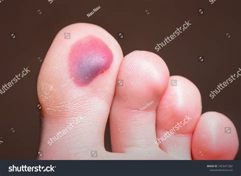 Blood Blister Supportive Therapy