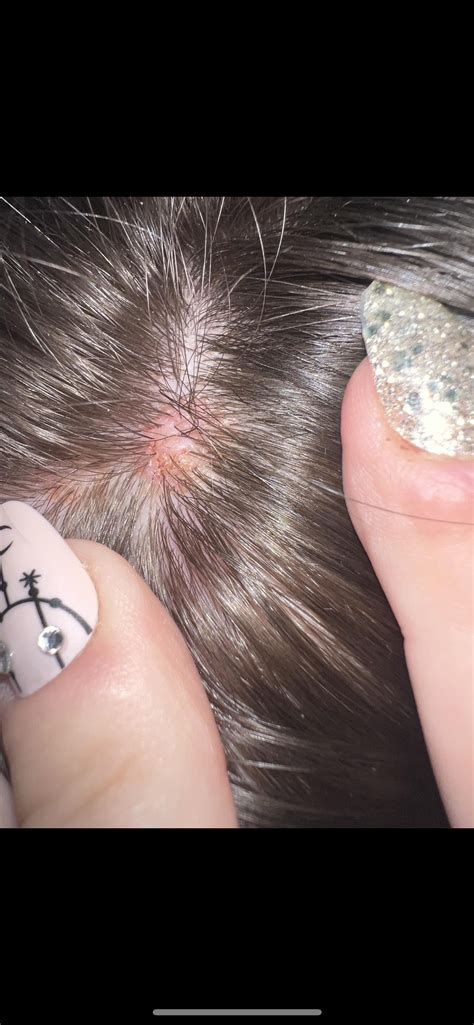 I have 2 hard lumps on my scalp. One is bigger than the other. Almost feel like lipomas.I Had ...