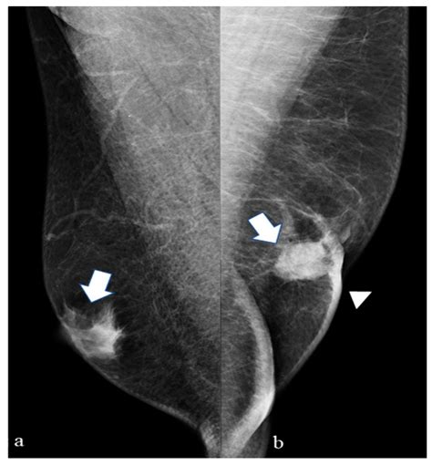 Radiological Features of Male Breast Neoplasms: How to Improve the Management of a Rare Disease