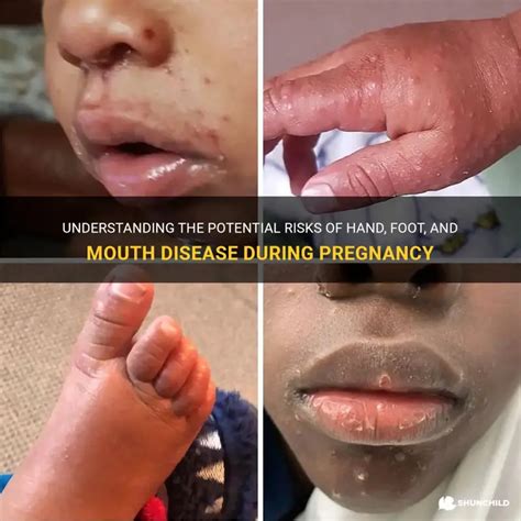 Understanding The Potential Risks Of Hand, Foot, And Mouth Disease ...