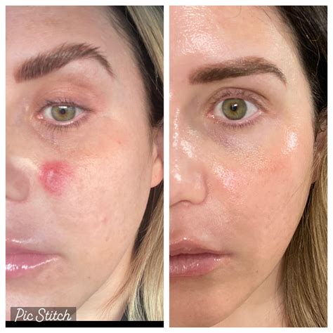 Fluorouracil Cream Before And After A And B, Before And After