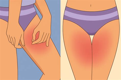 Chafing Inside Thighs