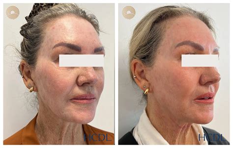 Do Co2 Laser Treatments Work at Kathleen Flores blog