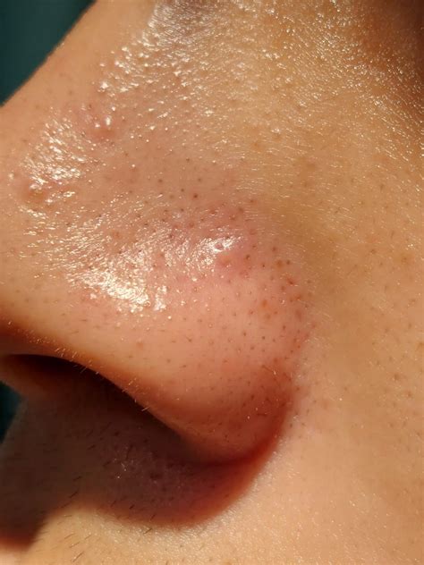 Oily nose, bumps, red rings, SFs, blackheads : r/SkincareAddicts