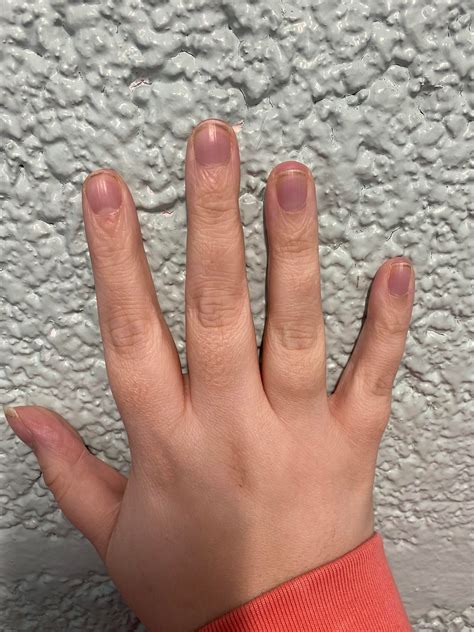 Raynauds? I get cold aching hands, splinter hemorhages and my fingers ...