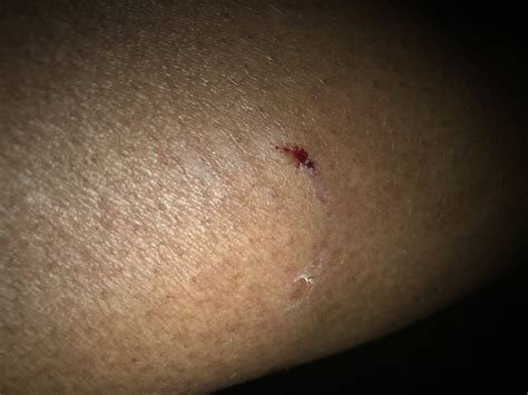 Rabies Bite Mark