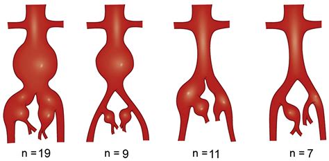 Endovascular treatment of hypogastric artery aneurysms - Journal of Vascular Surgery