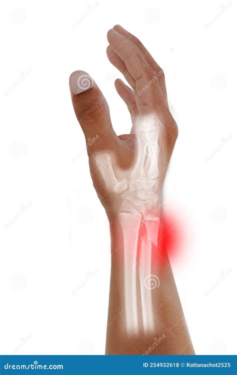 Hand, Wrist X-ray Oblique View Fracture Distal Ulna Pain and Swelling ,Medical Image Concept on ...