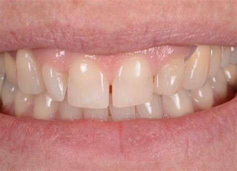 Gum Abscess Popped? Thinking of Popping It Yourself?