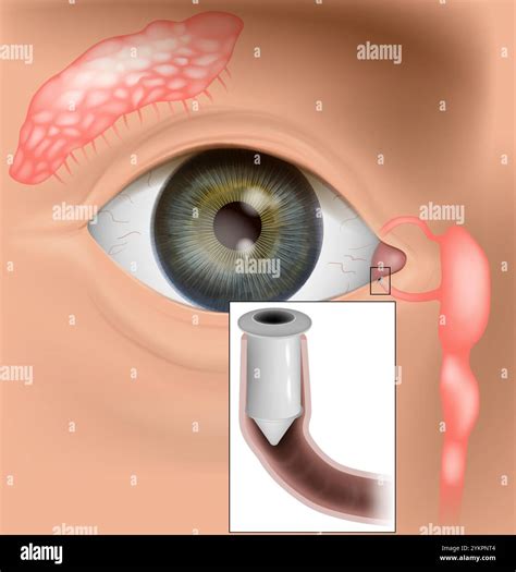 Punctal Occlusion Therapy. Punctal Plugs for Treatment of dry eye syndrome Stock Vector Image ...