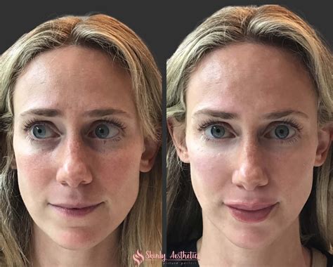 Juvederm Fillers - Benefits, Costs, Results & Procedure Steps