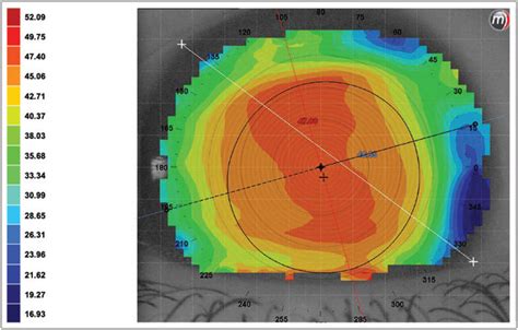 Older Age, Female Sex Risk Factors for Myopic Regression After ...