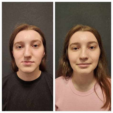 TMJ Surgery Before and After Photos – Prof. Dr. Celal Çandırlı